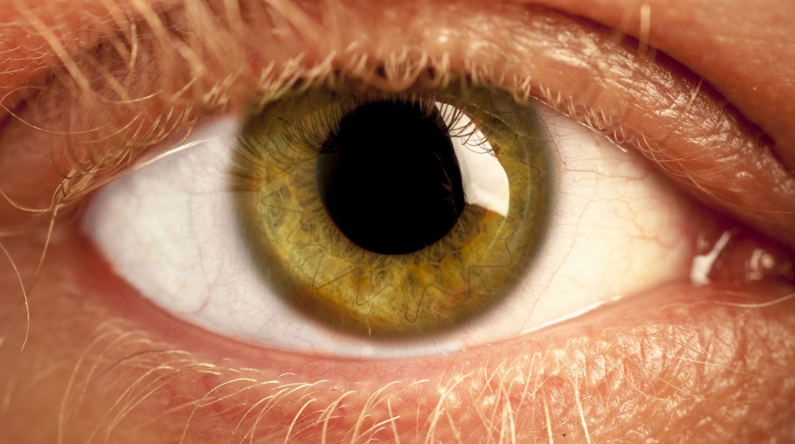 Cuerpo extraño corneal